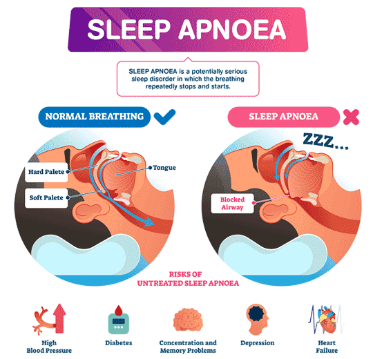 Sleep Apnoea Knowledge Centre | Sleep Apnoea Diagnosis & Treatment